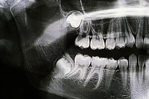 Panoramic X-ray of the jaw. X-ray of the teeth of a 12-year-old girl photo