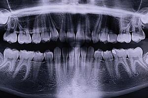 Panoramic X-ray of the jaw. X-ray of the teeth of a 12-year-old girl photo