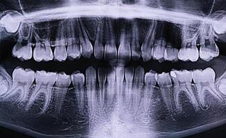Panoramic X-ray of the jaw. X-ray of the teeth of a 12-year-old girl photo