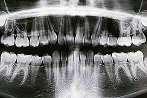 Panoramic X-ray of the jaw. X-ray of the teeth of a 12-year-old girl photo