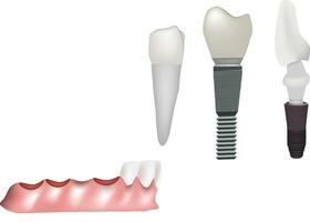 Different types of dental implants replacing missing teeth vector