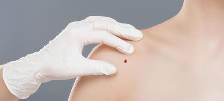 A medical professional wearing white gloves is examining a patients shoulder for a mole. They are conducting a skin health checkup, focusing on detecting any potential abnormalities, cropped photo