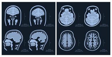 MRI image of a human brain showing all the major manifestations of multiple sclerosis. vector