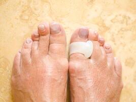 Treatment and prevention of hallux valgus. Silicone finger separator. High quality photo
