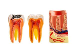 Decay tooth replace with dental implant root canal teeth model for education isolated on white background. photo