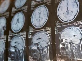 MRI of the human brain of a patient with multiple sclerosis of the initial stage. Close-up X-ray photo
