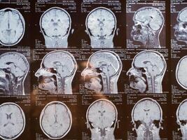 MRI of the human brain of a patient with multiple sclerosis of the initial stage. Close-up X-ray photo