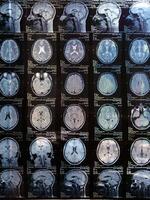 MRI of the human brain of a patient with multiple sclerosis of the initial stage. Close-up X-ray vertical photo