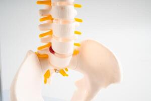 Lumbar spine displaced herniated disc fragment, spinal nerve and bone. Model for treatment medical in the orthopedic department. photo