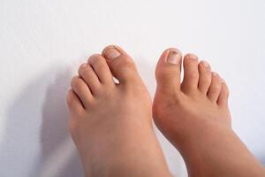 Close-up of a young boy's feet. Left large toenail is about to complete regrowth. Copy space for text. photo