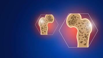 Bones osteoporosis trauma and paint blue background. editable vector