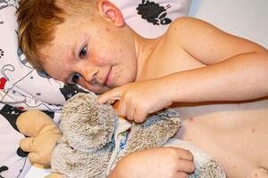 Varicella virus or Chickenpox bubble rash on child photo