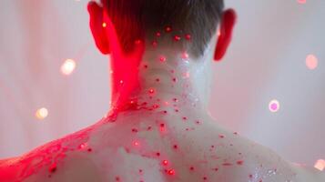 A persons back covered in red marks from cupping therapy which is often used in conjunction with cryotherapy for recovery photo