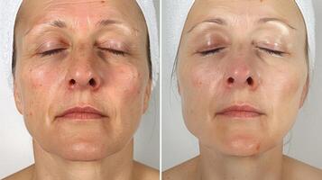 A before and after photo of someones face the first showing signs of tension and stress and the second after a cryotherapy session with a noticeable reduction in stress lines