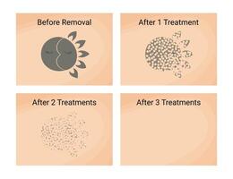 Laser Tattoo Removal Procedure before and after vector