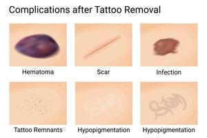 Skin issues following tattoo removal. Hematoma formation and scar, infection risks, pigment remnants, hypopigmentation, hyperpigmentation. vector