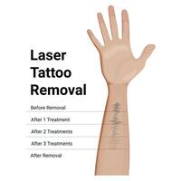 Laser Tattoo Removal Procedure, result before and after vector