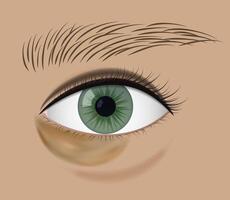Close-Up of Eye with yellow Under-Eye Bruise vector