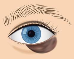 Close-Up of Eye with brown Under-Eye Bruise vector