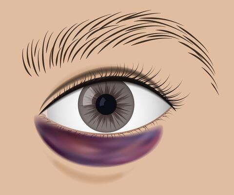 Detailed illustration of an eye with a dark purple bruise below, facial injury, medical condition. Swelling and discoloration, indicating trauma or impact. Medical and healthcare.