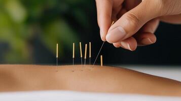A close-up of a hand applying acupuncture needles onto a person's arm, showcasing the technique of traditional Chinese medicine for holistic healing and pain relief. photo