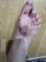 Injured Foot with Bruising and Blood photo