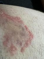 Close-up of Inflamed Skin Condition on Thigh photo