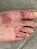 Close-Up of Irritated Human Foot photo