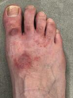 Close-Up of Inflamed Human Foot with Skin Irritation photo