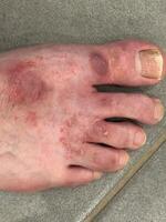 Close-Up of Irritated Foot Skin photo