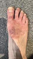 Close-Up of Inflamed Human Foot photo