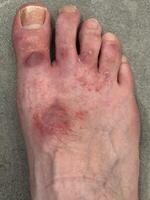Close-up of Inflamed Human Foot with Skin Irritation photo