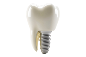 Tooth with implant isolated on transparent background. png