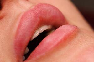 A close up of a womans lips one month after the procedure. A natural shade and neat contours show the healing process is complete. photo