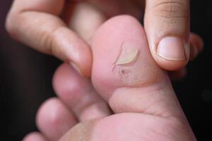 A CloseUp Image Showing a Foot with an Ingrown Toenail Being Examined by a Professional photo