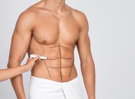 Plastic Surgery. Man's Fit Torso With Surgical Lines On His Body Before Operation. Doctor's Hand Drawing Black Marks photo