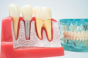Artificial tooth roots dental implant into jaw, Root canal model for dentist. photo