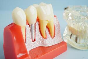 Artificial tooth roots dental implant into jaw, Root canal model for dentist. photo