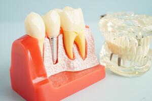 Artificial tooth roots dental implant into jaw, Root canal model for dentist. photo