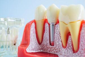 Artificial tooth roots dental implant into jaw, Root canal model for dentist. photo