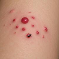 Images depicting human skin with visible bed bug bites Infectious Medical Illustration photo