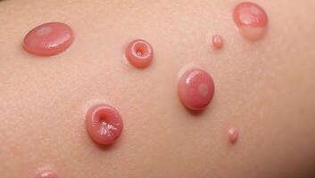 Images depicting human skin with visible bed bug bites Infectious Medical Illustration photo