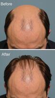 BeforeandAfter image showcasing clinical transformation from hair loss to restored hair using a restorative treatment photo