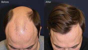 BeforeandAfter image showcasing clinical transformation from hair loss to restored hair using a restorative treatment photo