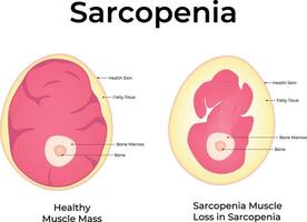 Sarcopenia Science Design Illustration Diagram vector