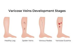 Varicose Veins Development Stages Science Design Illustration Diagram vector