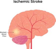 Ischemic Stroke Science Design Illustration Diagram vector