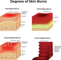 Degrees of Skin Burns, skin burn. Three Degrees of Burns. Type of Injury to Skin. Step of Burn. vector