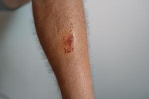 Scratch marks on skin surface cause by sharp fingernails scratching an itch, closeup macro view. Scar on a man's thigh caused by scratching on itchy skin. Healing cut wound on a person's flesh. photo