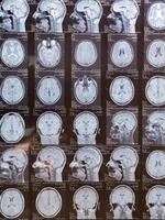 MRI of the human brain of a patient with multiple sclerosis of the initial stage. Close-up X-ray vertical photo